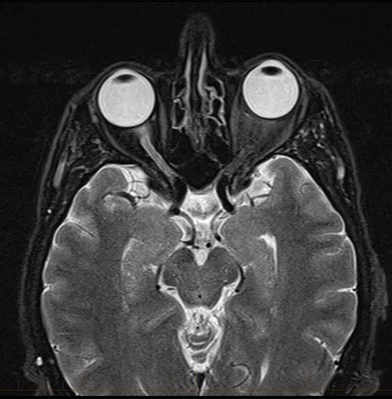 MRI brain scan with contrast 3