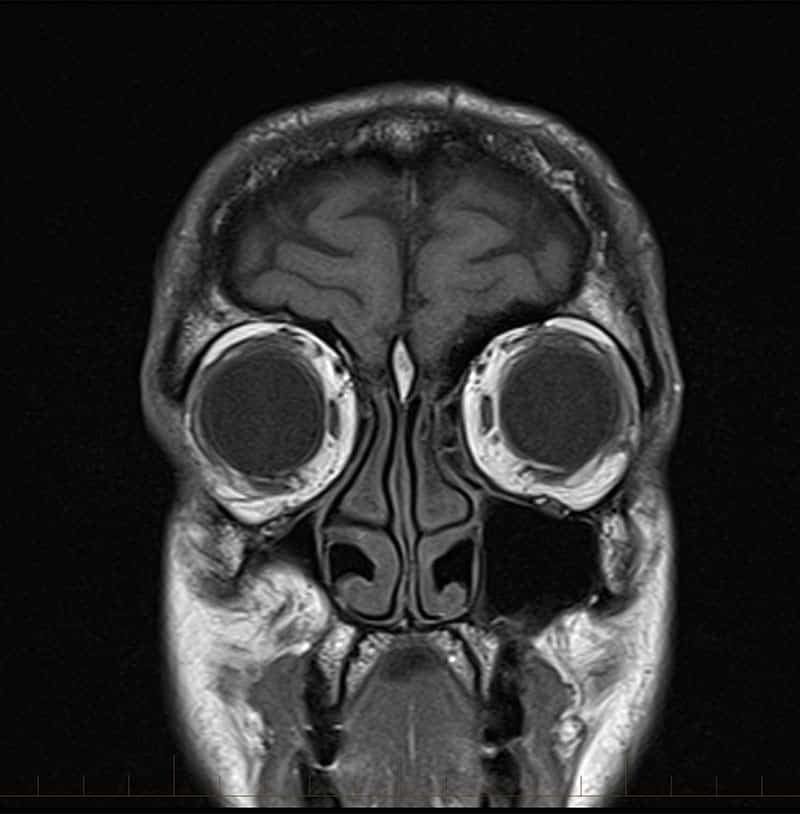 MRI brain scan with contrast 4