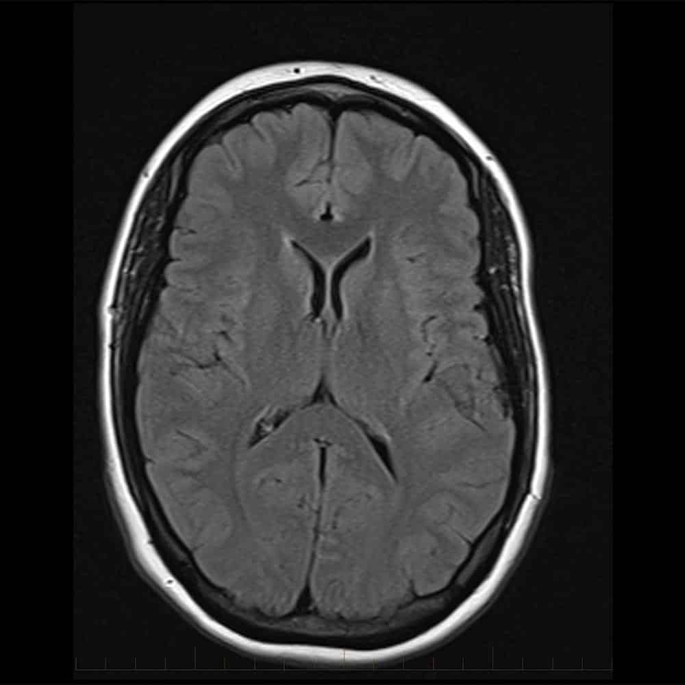 MRI brain scan with contrast - Melbourne Radiology