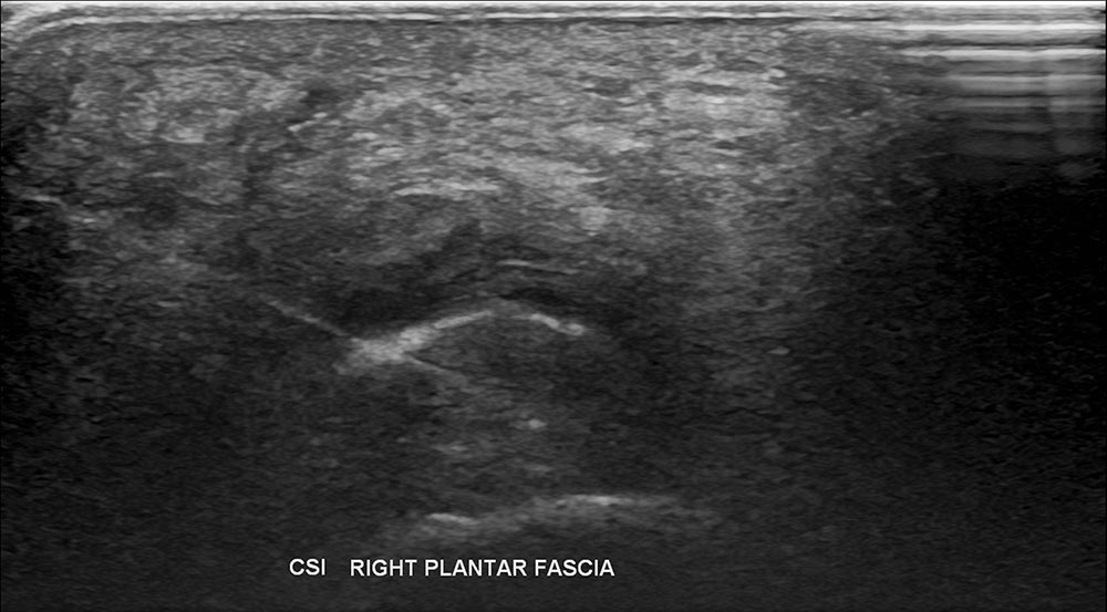 Right Plantar Fasciitis Ultrasound 3 - Melbourne Radiology