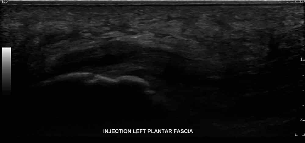 Left Plantar Fasciitis Ultrasound 3 - Melbourne Radiology