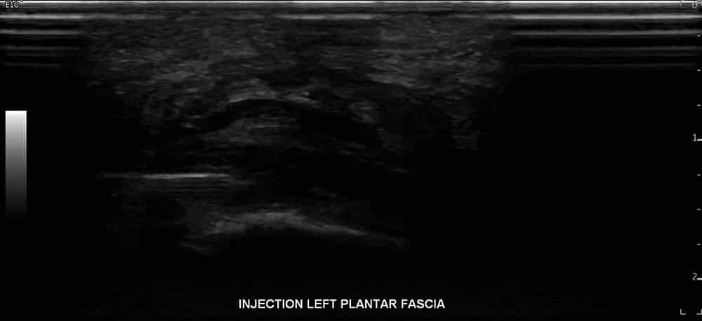 Left Plantar Fasciitis Ultrasound 2 - Melbourne Radiology
