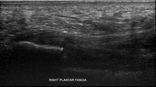 Right Plantar Fasciitis Ultrasound 2 - Melbourne Radiology