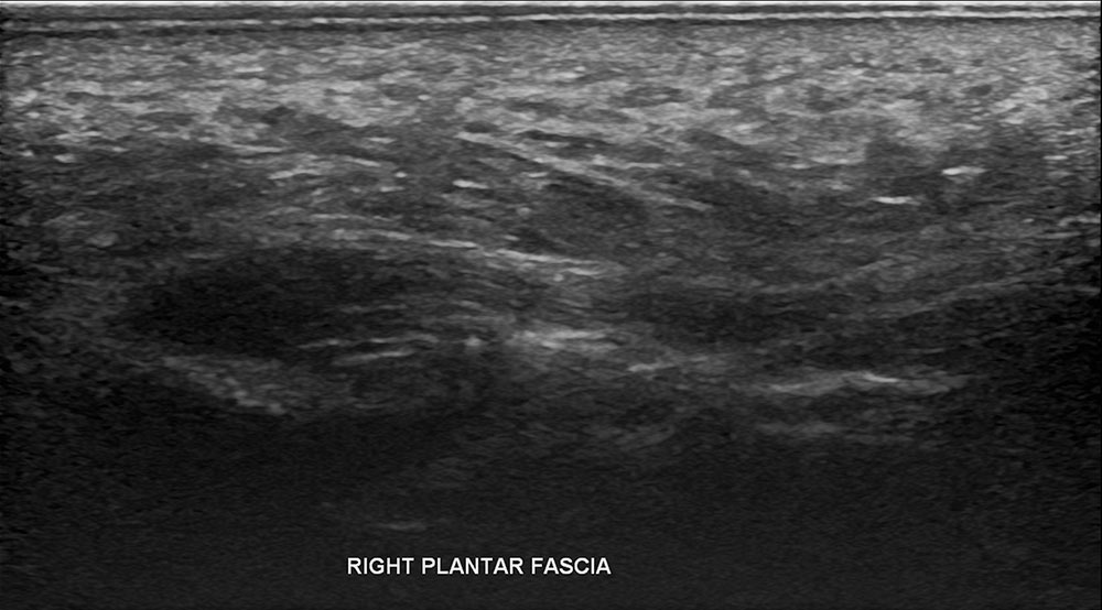 Right Plantar Fasciitis Ultrasound - Melbourne Radiology