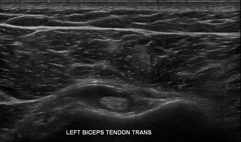 Left Biceps Ultrasound 2 - Melbourne Radiology