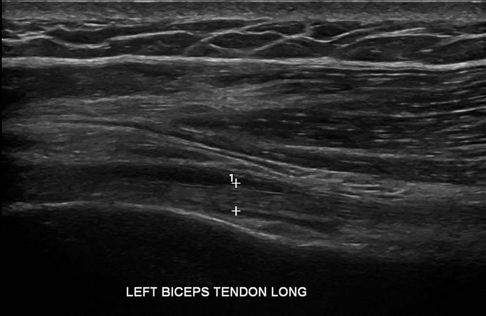 Left Biceps Ultrasound - Melbourne Radiology