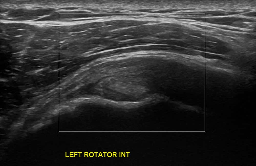 Left Shoulder Ultrasound 2 - Melbourne Radiology