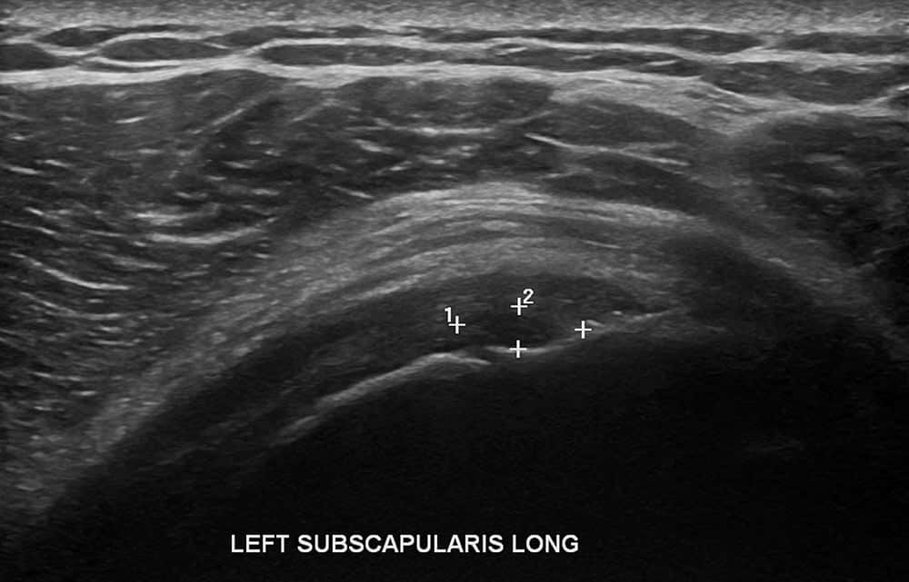 Shoulder Ultrasound 2 - Melbourne Radiology