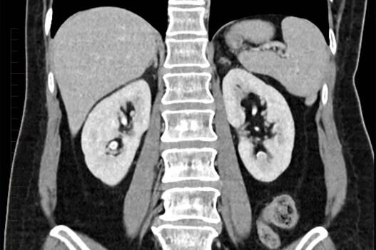 CT Scan of Both Kidneys - Melbourne Radiology