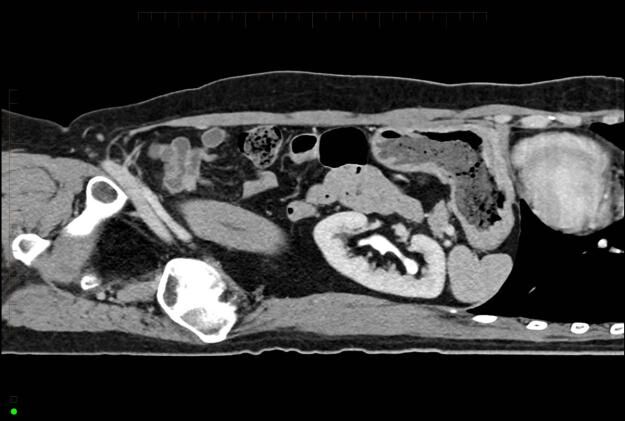 CT Scan of Kidney 3 - Melbourne Radiology