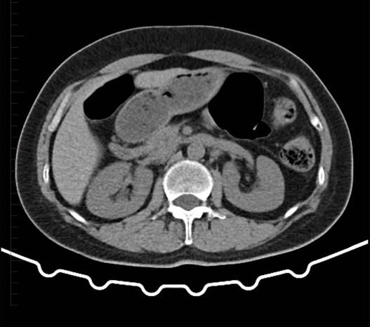 CT Scan of Kidney 4 - Melbourne Radiology