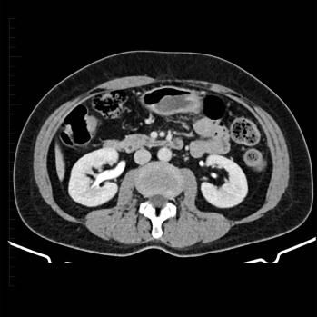 CT Scan Kidney 3 - Melbourne Radiology