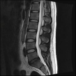Lumbar Spine MRI 2 - Melbourne Radiology