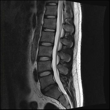 Usefulness of MRI for Low Back Pain