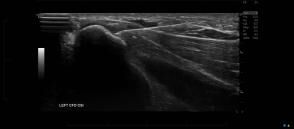Ultrasound Image of Elbow Pain Injection - Melbourne Radiology