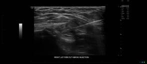 An Ultrasound Image of Right Lat Fem Cut Nerve Injection - Melbourne Radiology