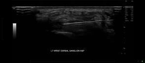 Ultrasound Image of Wrist Pain Injection - Melbourne Radiology