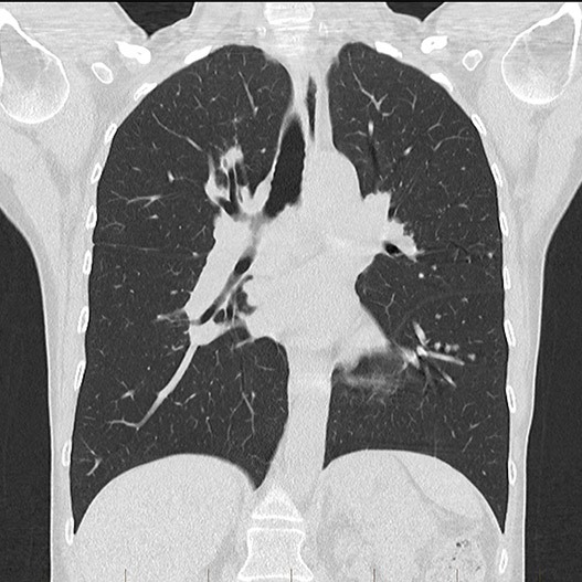 Chest CT Scan -Melbourne Radiology