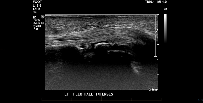 Foot Ultrasound 2 - Melbourne Radiology