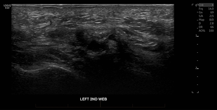 Foot Ultrasound - Melbourne Radiology