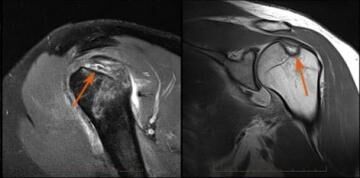 Shoulder Dislocation - Melbourne Radiology