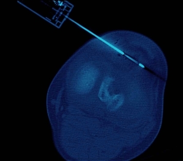 fine needle aspiration biopsy