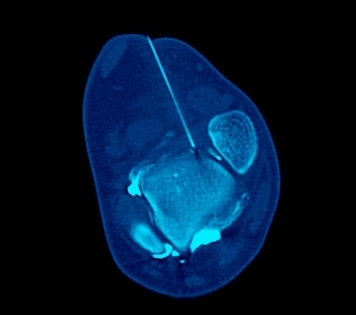 Musculoskeletal Injections - Ankle Arthrogram