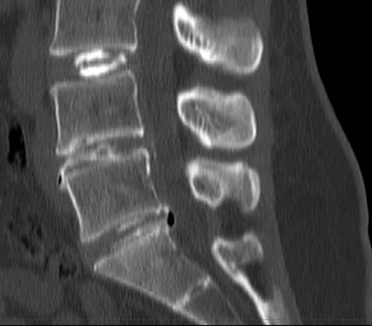 Sagittal and coronal reformatted images following discogram (A)