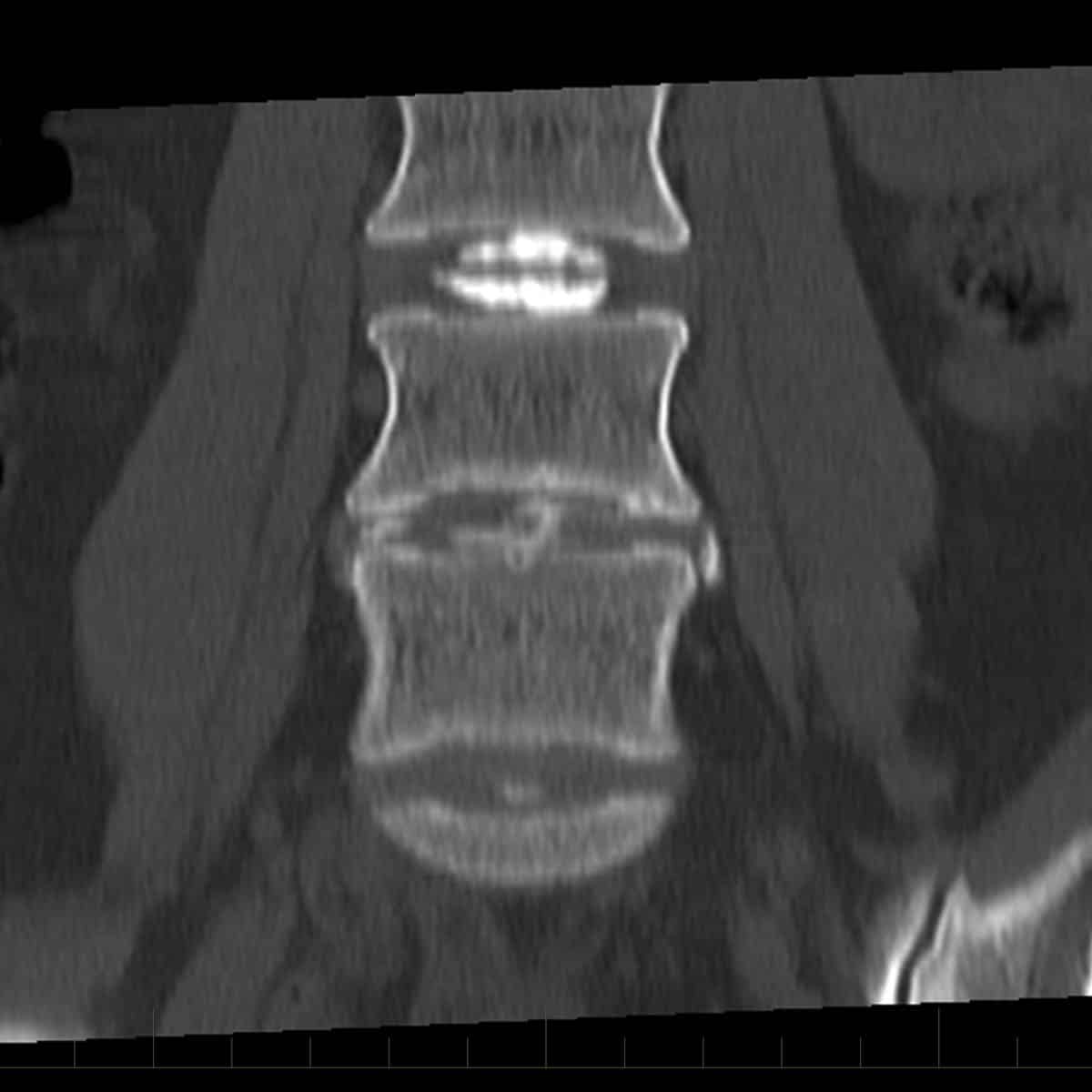 Sagittal and coronal reformatted images following discogram (B)