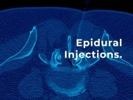 Epidural Injections - Patient Guide