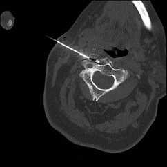 Radiofrequency Ablation - Performed with CT imaging guidance to cervical spine - C1/2 lateral joint