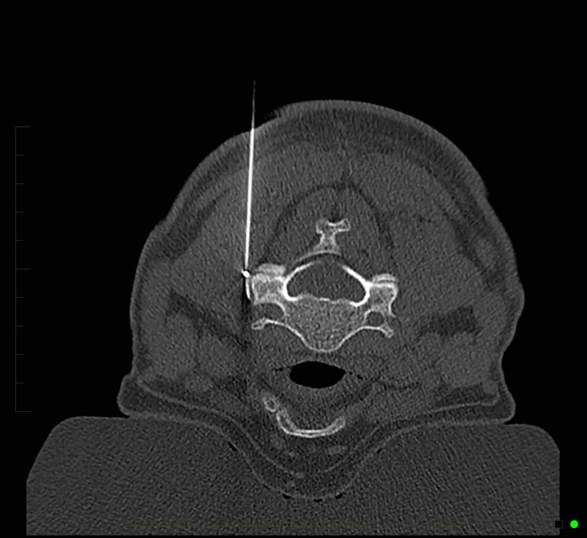 Radiofrequency Ablation - Performed with CT imaging guidance to treat facet joint pain in cervical spine