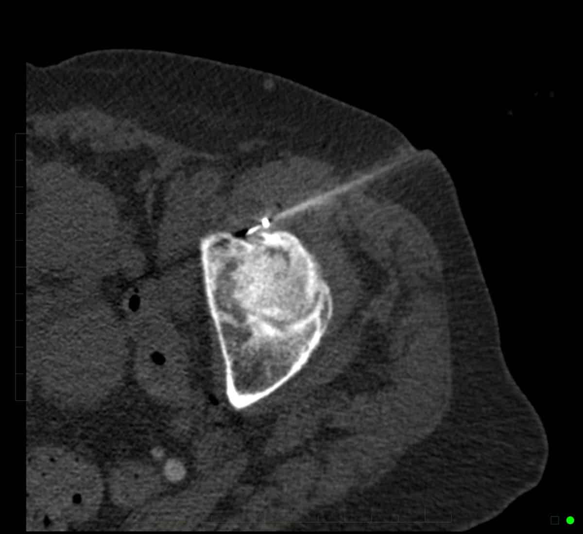 RFA – performed with CT imaging to treat pain arising from the hip joint