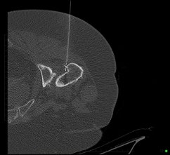 Radiofrequency Ablation - Performed with CT imaging guidance to treat trochanteric pain syndrome