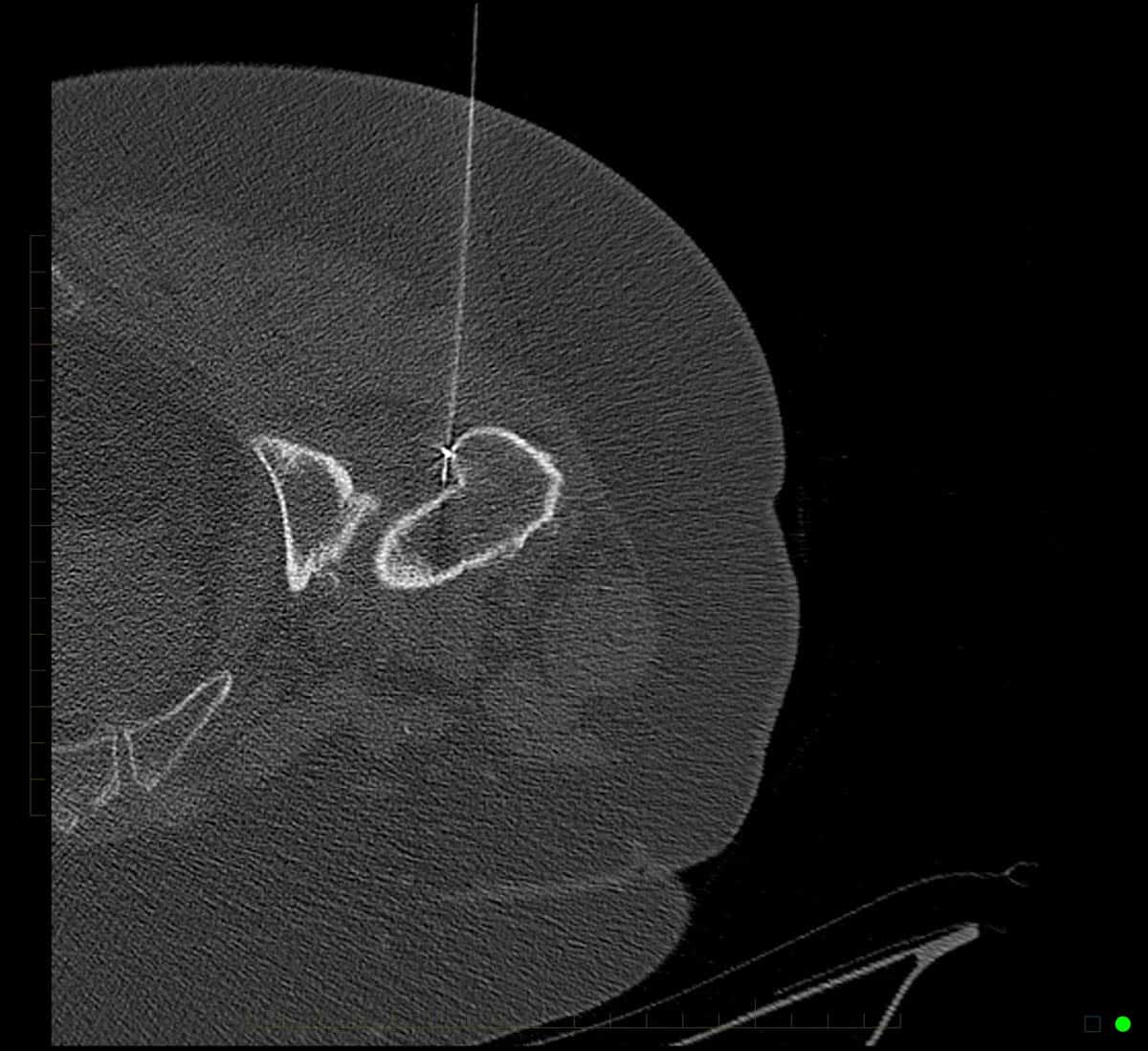 Radiofrequency Ablation - Performed with CT imaging guidance to treat trochanteric pain syndrome