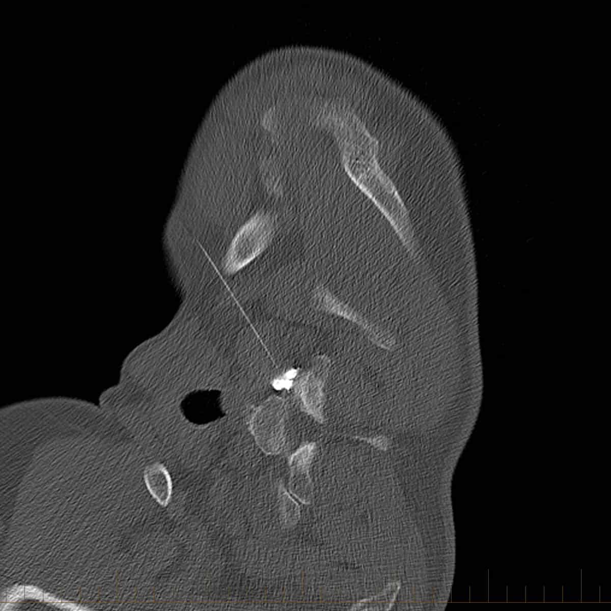 Selective nerve root block (SNRB)