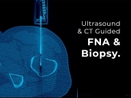 Fine Needle Aspiration (FNA) and Biopsy - Patient Guide