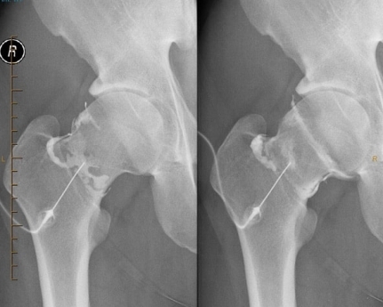 Hip Arthrogram - Melbourne Radiology Clinic