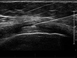 ultrasound guided knee injection