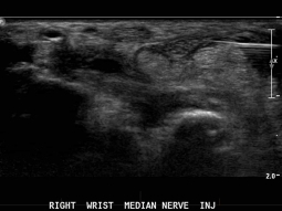 ultrasound guided injection to treat carpal tunnel syndrome