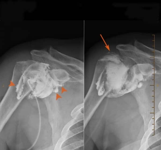 Shoulder Hydrodilatation - Left SHoulder