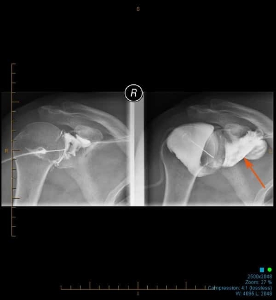 Shoulder Hydrodilatation - Right Shoulder