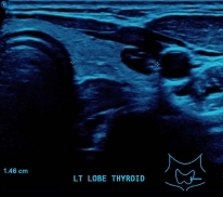 thyroid ultrasound