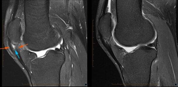 Autologous Tendon Implantation Therapy - Figure A and B