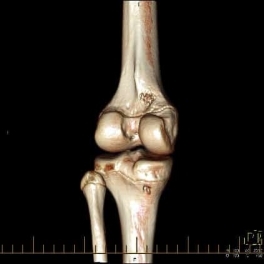 knee joint