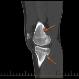 MRI of a knee