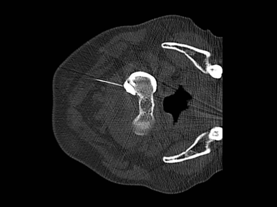 CT guided C1/2 facet joint injection with contrast demonstrating intra-articular position - 1A