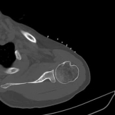 1. CT Guided Hydrodilatation