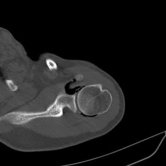 2. CT Guided Hydrodilatation