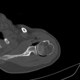 3. CT Guided Hydrodilatation